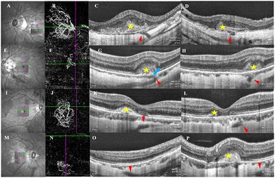 Perforating scleral vessels adjacent to myopic choroidal neovascularization achieved a poor outcome after intravitreal anti-VEGF therapy
